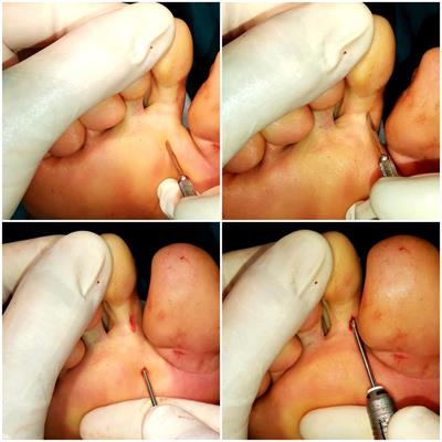 Comparative analysis of bone consolidation chronology in claw toes operated through minimal invasive osteotomies in diabetic vs. non-diabetic patients